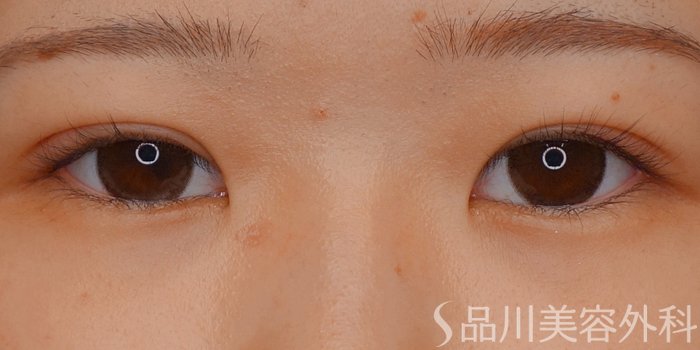 症例NO.72344のAFTER写真