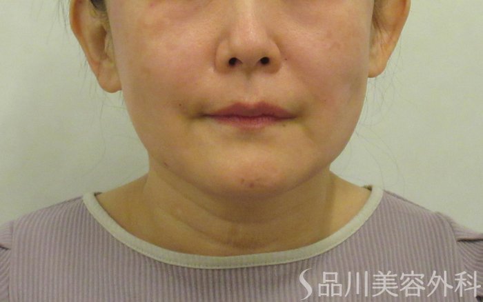 症例NO.72342のAFTER写真