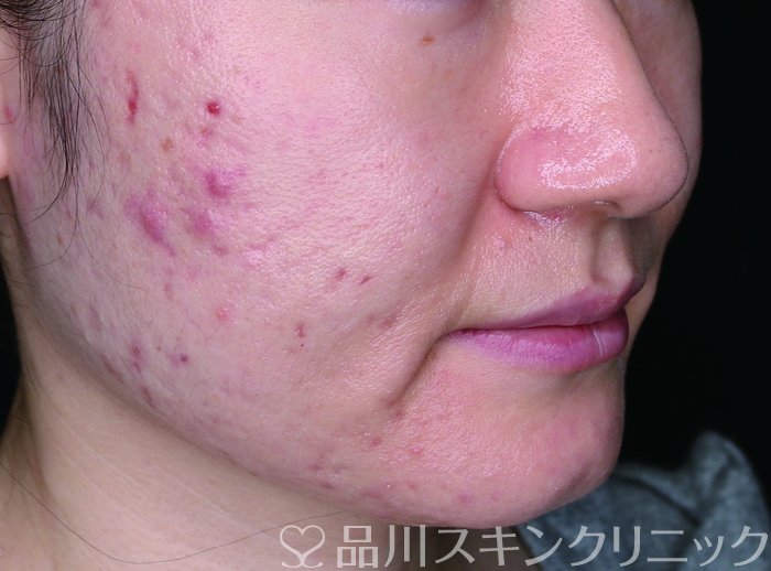 症例NO.65667のBEFORE写真