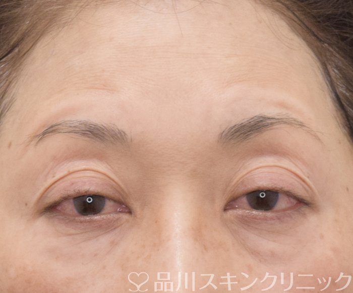 症例NO.74052のBEFORE写真