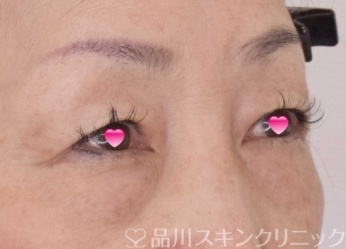 症例NO.69172のBEFORE写真