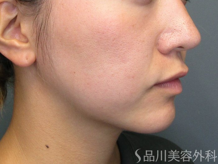 症例NO.75194のBEFORE写真