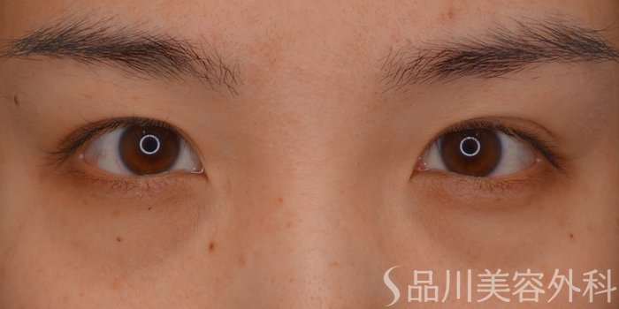 症例NO.75357のBEFORE写真