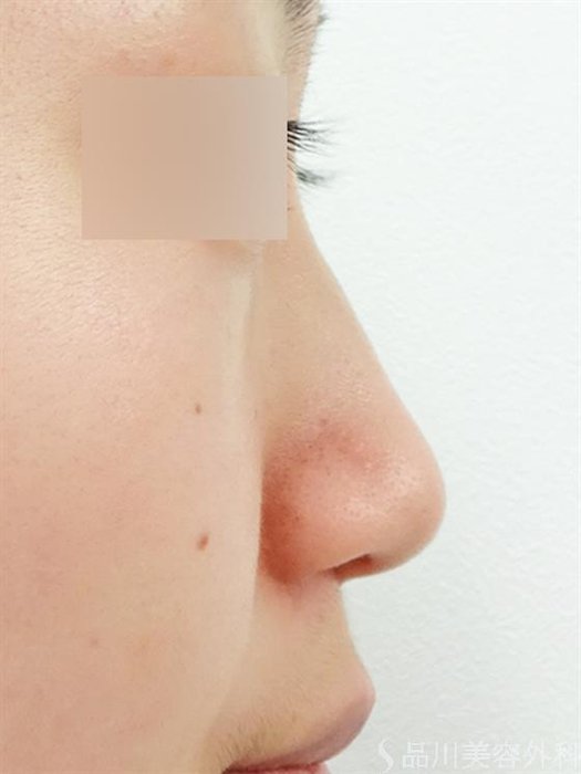 症例NO.33249のBEFORE写真