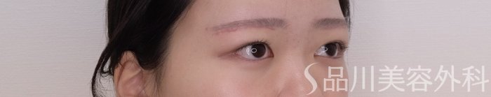 症例NO.69372のAFTER写真