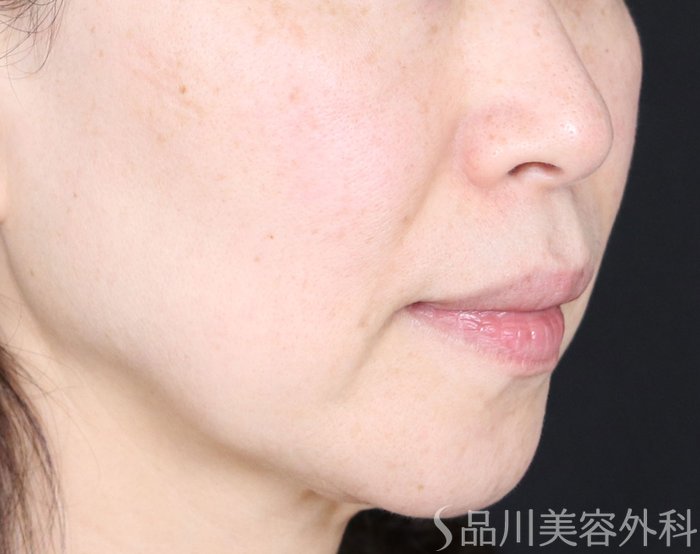 症例NO.71579のBEFORE写真