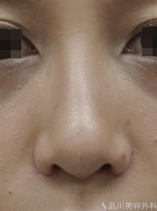 症例NO.16430のAFTER写真