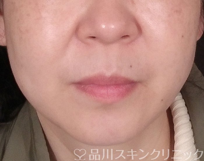症例NO.70060のAFTER写真