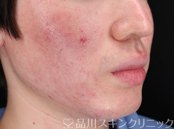 症例NO.73427のBEFORE写真