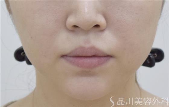症例NO.47547のAFTER写真