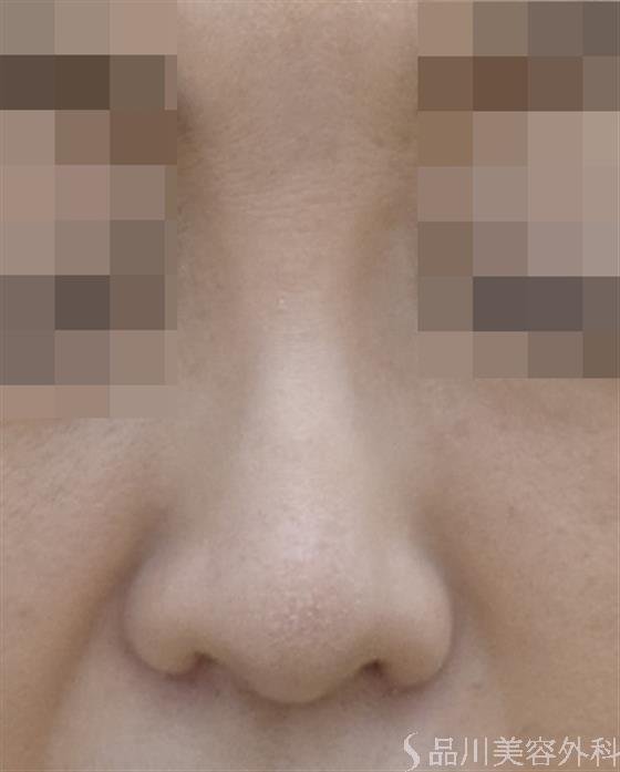 症例NO.46181のAFTER写真