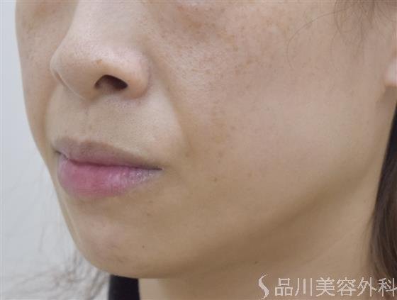 症例NO.51622のBEFORE写真