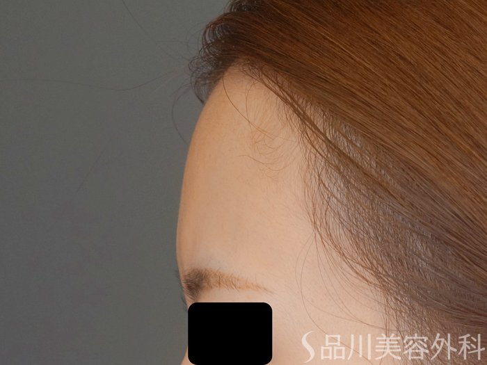 症例NO.69368のBEFORE写真