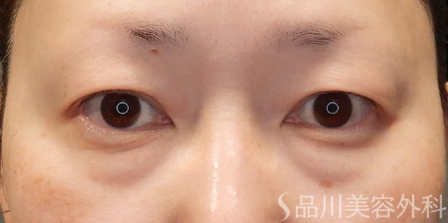 症例NO.74246のBEFORE写真