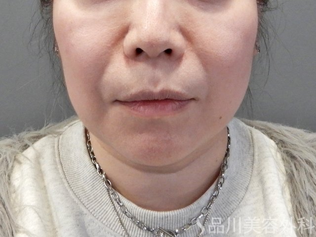 症例NO.69232のAFTER写真