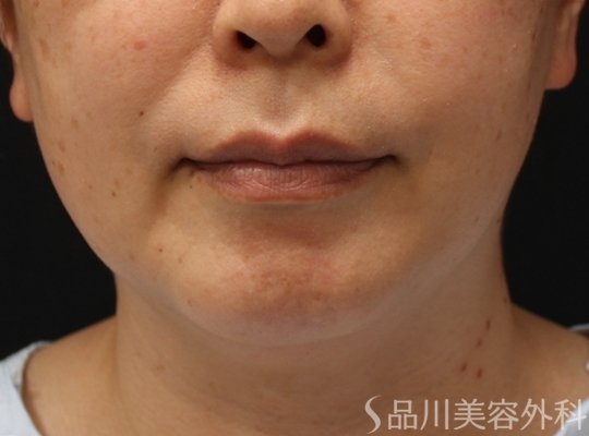 症例NO.71538のBEFORE写真