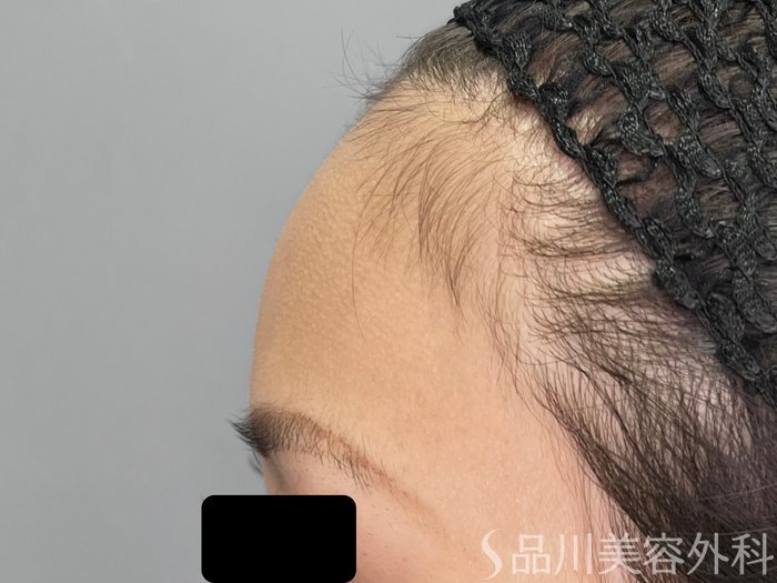 症例NO.70656のBEFORE写真