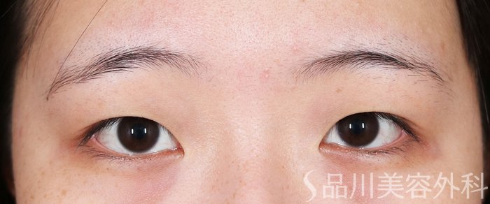 症例NO.71514のBEFORE写真