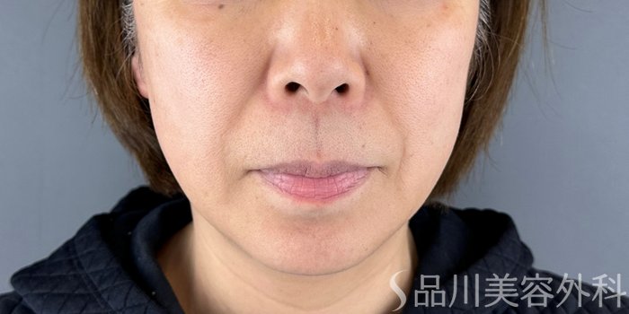 症例NO.69282のBEFORE写真