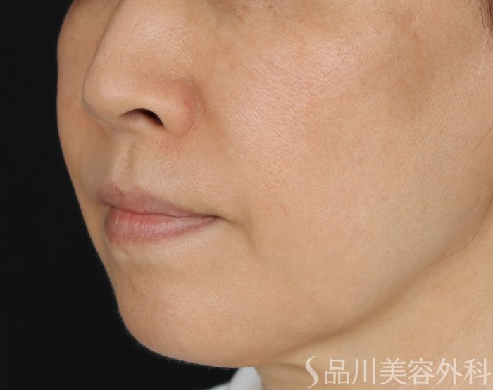 症例NO.71219のBEFORE写真