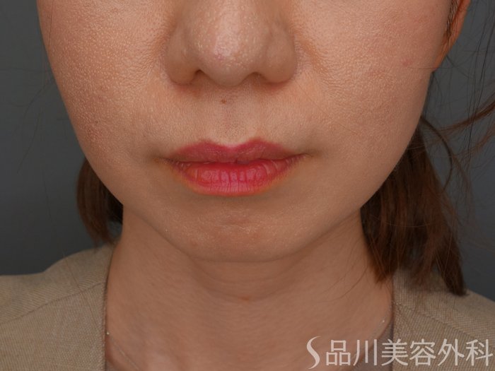 症例NO.74423のBEFORE写真