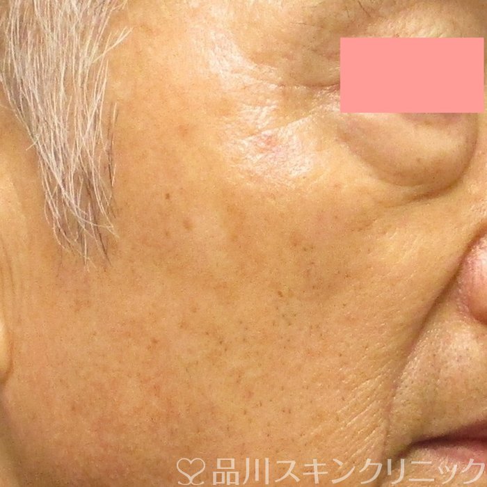症例NO.71048のAFTER写真