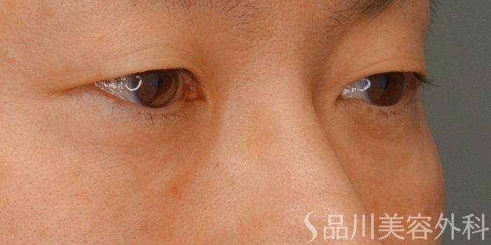 症例NO.71057のAFTER写真