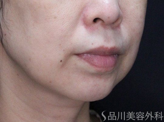 症例NO.71267のBEFORE写真