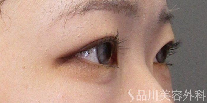 症例NO.75033のAFTER写真