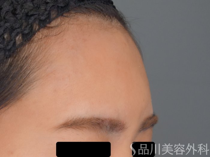 症例NO.69709のAFTER写真