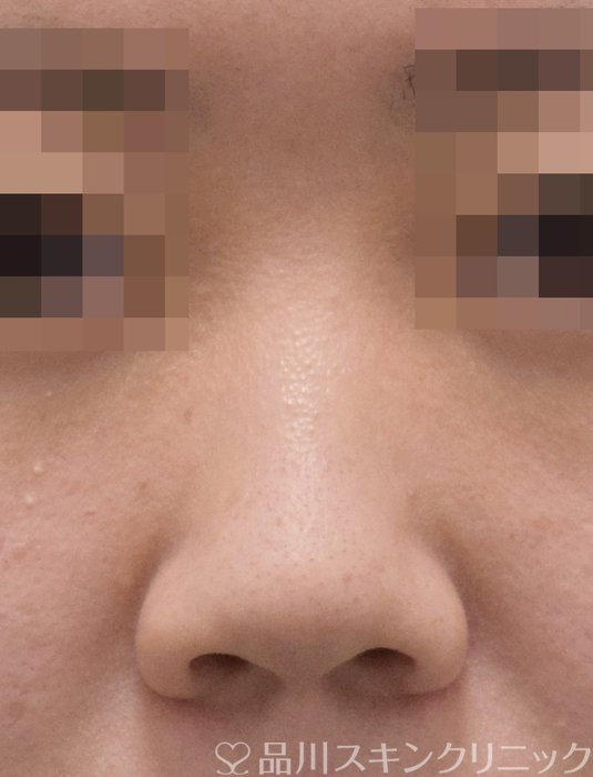 症例NO.71736のBEFORE写真