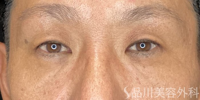 症例NO.72040のBEFORE写真