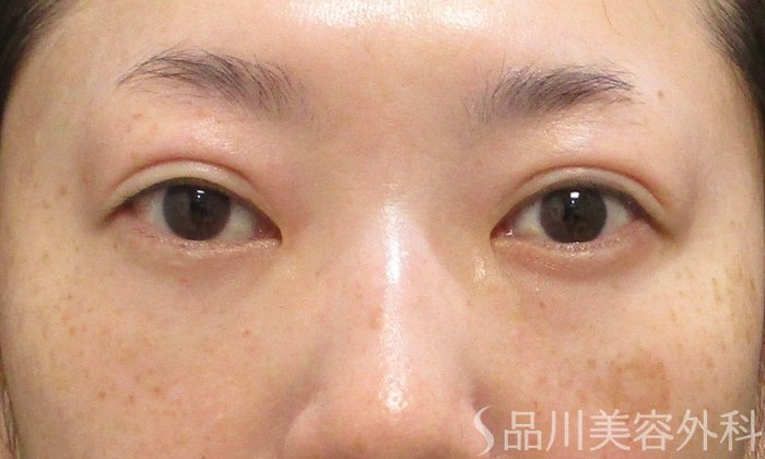症例NO.69796のAFTER写真