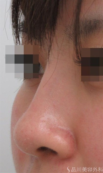 症例NO.26328のAFTER写真