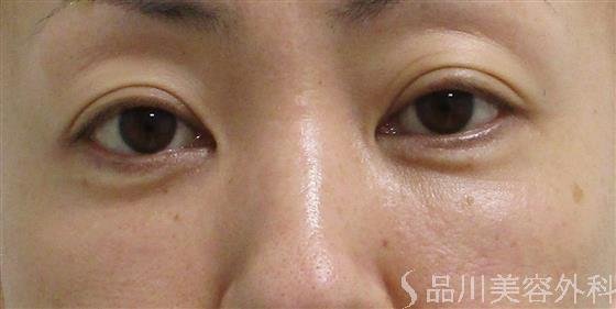 症例NO.55430のAFTER写真