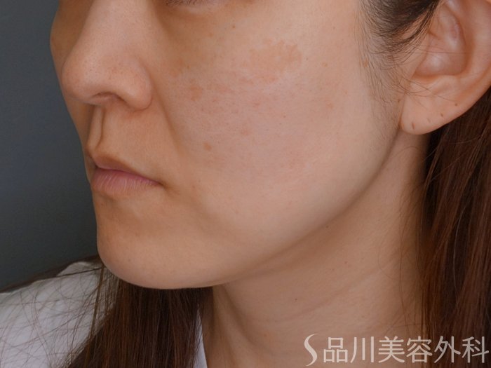 症例NO.74791のBEFORE写真