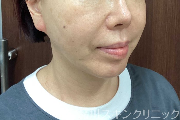 症例NO.71291のAFTER写真