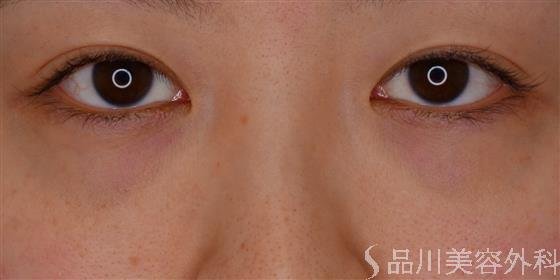 症例NO.60593のBEFORE写真