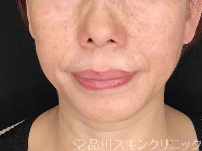 症例NO.64266のBEFORE写真