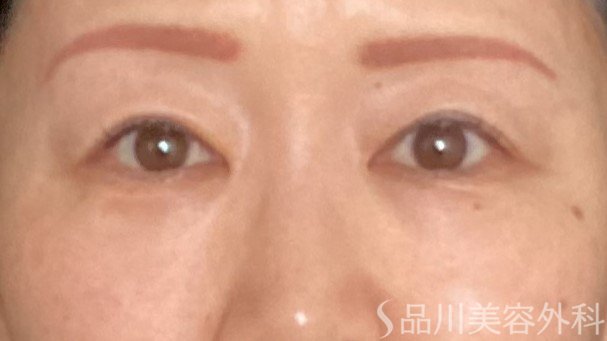 症例NO.65046のBEFORE写真