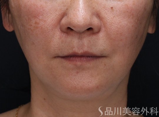 症例NO.73097のAFTER写真