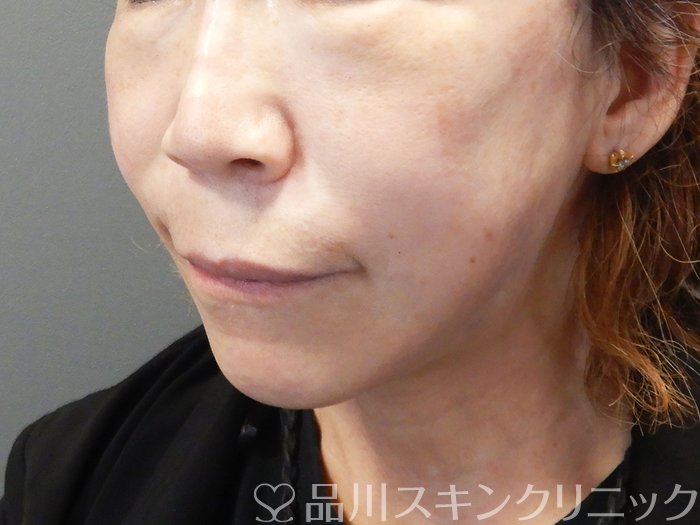 症例NO.72486のAFTER写真