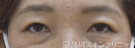 症例NO.53597のAFTER写真