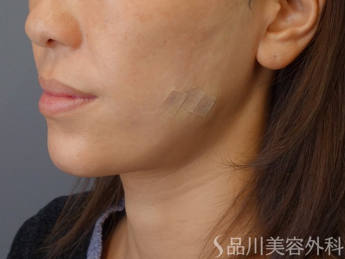症例NO.72597のAFTER写真