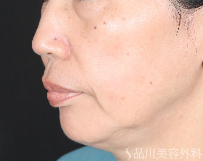 症例NO.72107のBEFORE写真