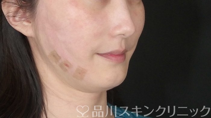 症例NO.72681のAFTER写真