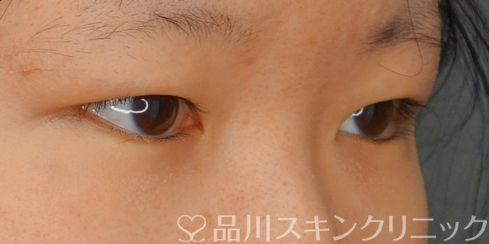 症例NO.71543のBEFORE写真