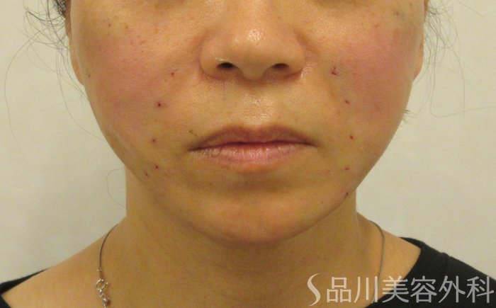 症例NO.72193のAFTER写真