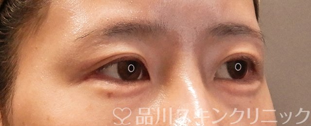 症例NO.70551のAFTER写真