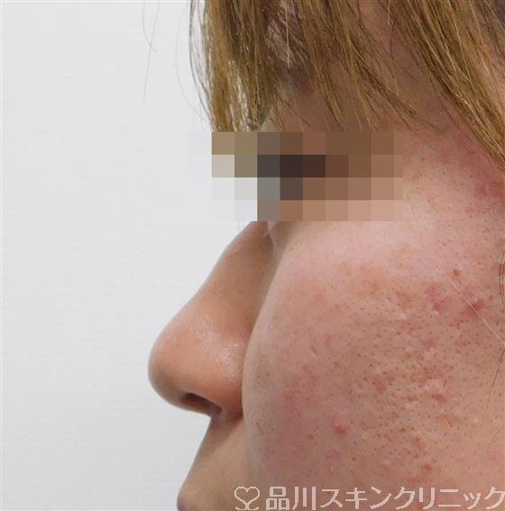 症例NO.55378のBEFORE写真